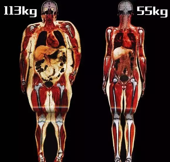 相同身高下，肥胖者與正常者皮下脂肪對比
